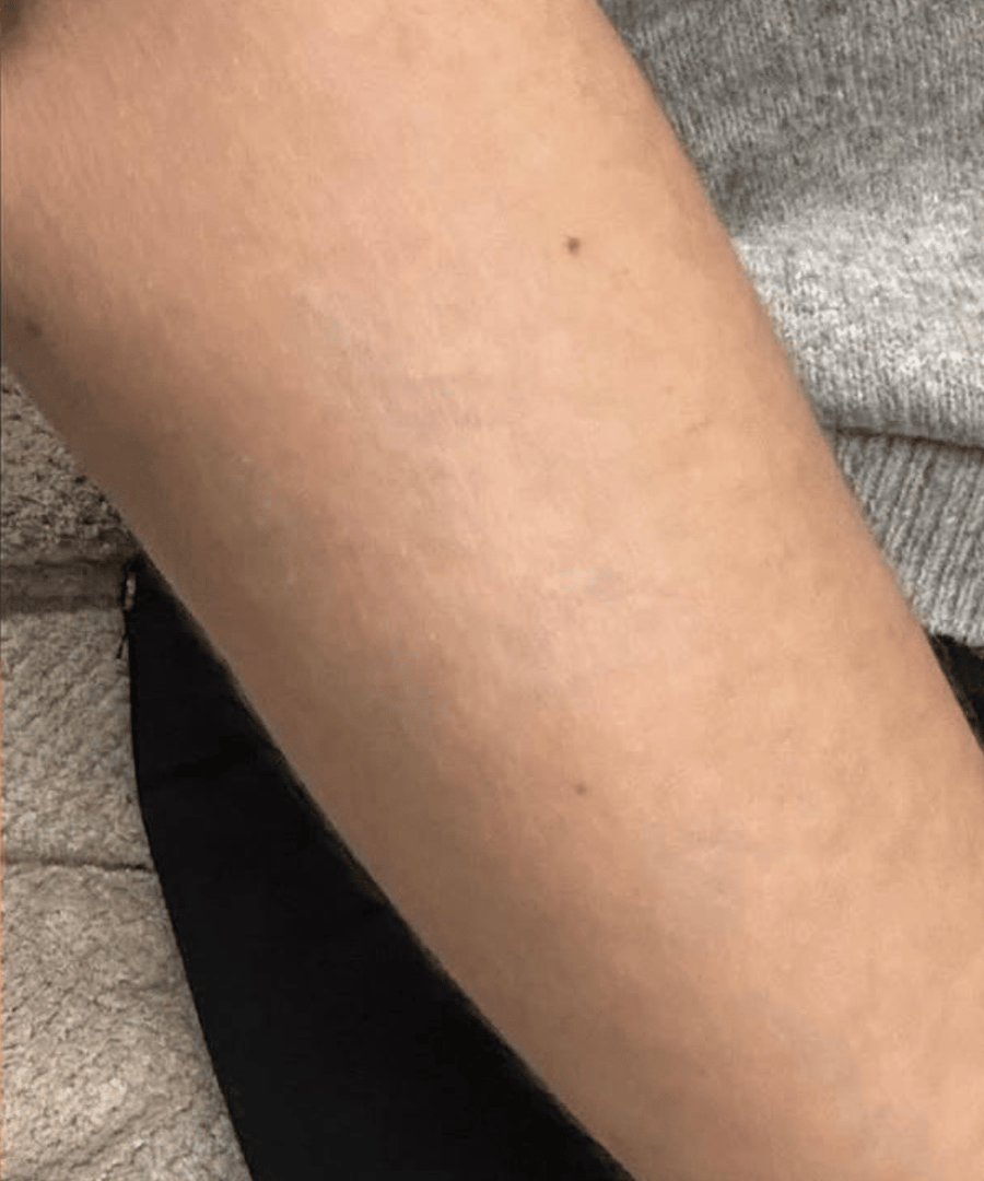 Voor en na resultaat van tattoo verwijderen met laser